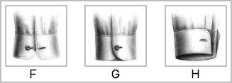 Cuff types FGH